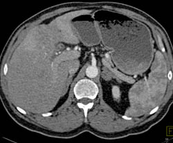 Hepatoma - CTisus CT Scan