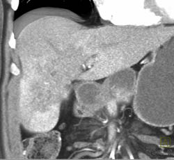 Hepatoma - CTisus CT Scan