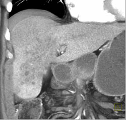 Hepatoma - CTisus CT Scan