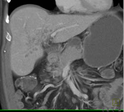 Cholangiocarcinoma - CTisus CT Scan