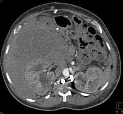 Large Hepatoma With Neovascularity - CTisus CT Scan