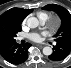 Pulmonary Embolism (PE) and Deep Vein Thrombosis (DVT) S/P Hepatic Resection - CTisus CT Scan