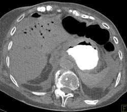 Ischemic Bowel With Portal Venous Air - CTisus CT Scan