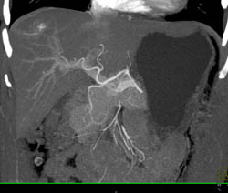 Hemangioma - CTisus CT Scan