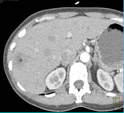 Liver Abscess - CTisus CT Scan