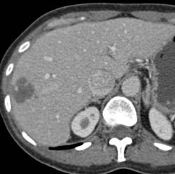 Hemangioma - CTisus CT Scan