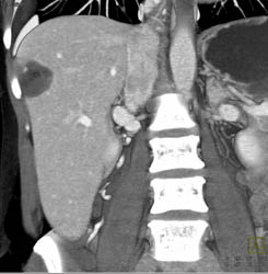 Hemangioma - CTisus CT Scan