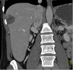 Hemangioma - CTisus CT Scan