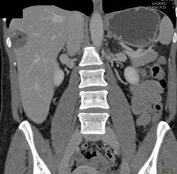 Hemangioma - CTisus CT Scan