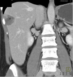 Hemangioma - CTisus CT Scan