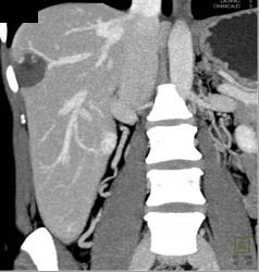 Hemangioma - CTisus CT Scan