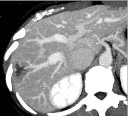 Hemangioma - CTisus CT Scan