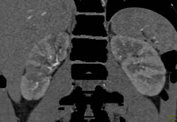 Bone Editing and Polyarteritis Nodosa Involves Liver and Kidney - CTisus CT Scan