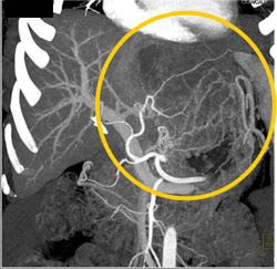 Hepatoma - CTisus CT Scan