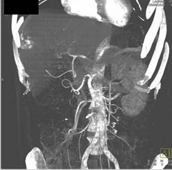 Hemangioma - CTisus CT Scan