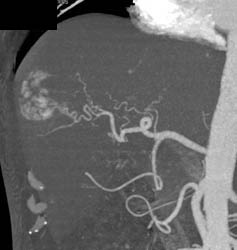 Hemangioma - CTisus CT Scan