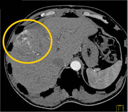 Hemangioma - CTisus CT Scan