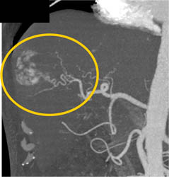 Hemangioma - CTisus CT Scan