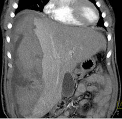 Subcapsular Bleed Due to Hepatic Adenoma - CTisus CT Scan