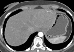 Multiple Hepatic Adenomas - CTisus CT Scan