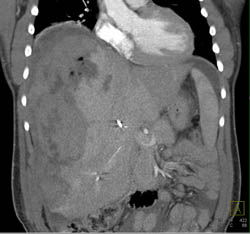 Subcapsular Hematoma Due to Bleed of Hepatic Adenoma - CTisus CT Scan