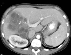 Biliary Cystadenocarcinoma - CTisus CT Scan