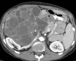 Biliary Cystadenocarcinoma - CTisus CT Scan