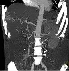 Hemangioma - CTisus CT Scan