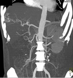 Hemangioma - CTisus CT Scan