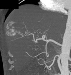 Hemangioma - CTisus CT Scan