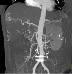 Hemangioma - CTisus CT Scan