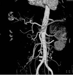 Hemangioma - CTisus CT Scan