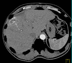 Hemangioma - CTisus CT Scan