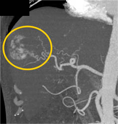 Hemangioma - CTisus CT Scan