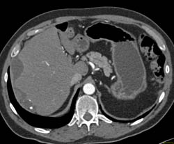 Implants Due to Ovarian Cancer - CTisus CT Scan