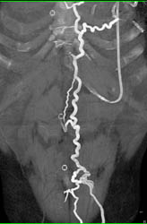 Hot Spot Liver Due to SVC Occlusion - CTisus CT Scan