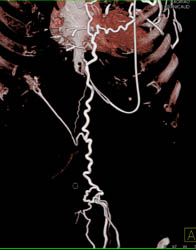 Hot Spot Liver Due to SVC Occlusion - CTisus CT Scan