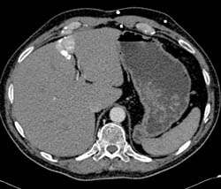 Hot Spot Liver Due to SVC Occlusion - CTisus CT Scan