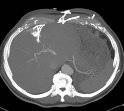 Hot Spot Liver Due to SVC Occlusion - CTisus CT Scan