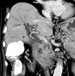 Cancer of the Pancreas Obstructs the Common Bile Duct (CBD) - CTisus CT Scan