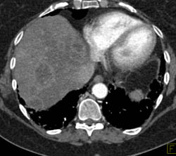 Pancreatic Cancer With Liver Metastases - CTisus CT Scan