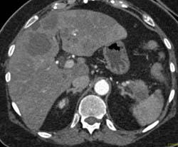 Pancreatic Cancer With Liver Metastases - CTisus CT Scan