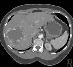 Giant Cavernous Hemangioma - CTisus CT Scan