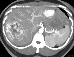 Giant Cavernous Hemangioma - CTisus CT Scan