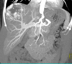 Giant Cavernous Hemangioma - CTisus CT Scan