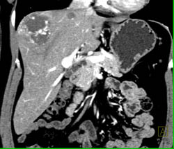 Giant Cavernous Hemangioma - CTisus CT Scan