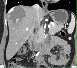 Giant Cavernous Hemangioma - CTisus CT Scan