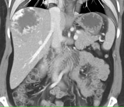 Giant Cavernous Hemangioma - CTisus CT Scan