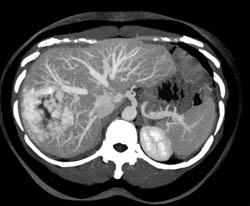 Giant Cavernous Hemangioma - CTisus CT Scan