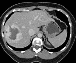 Giant Cavernous Hemangioma - CTisus CT Scan